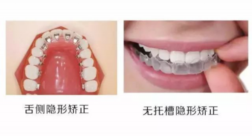 矫正牙齿导板带上有什么不适、矫正牙齿导板带上有什么不适的感觉(图1)